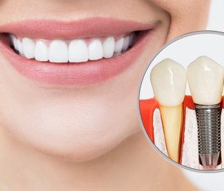 Can I Get Dental Implants if I Have Gum Disease?