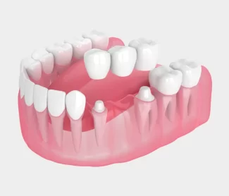 How Can I Fill the Gap from a Missing Tooth?